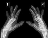 Arthritic hands,X-ray