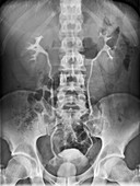 Healthy urinary tract,X-ray