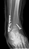 Pinned boken ankle,X-ray