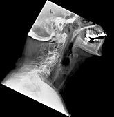 Arthritis of the neck,X-ray