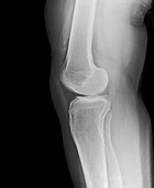 Removed kneecap,X-ray