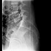 Fractured vertebra,X-ray