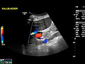 Gallstone,ultrasound scan