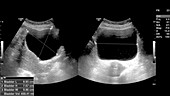Polycystic kidneys,ultrasound scan