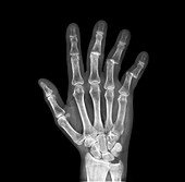 Dislocated fingers,X-ray