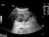 Secondary liver cancer,ultrasound scan