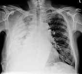 Mesothelioma lung cancer,X-ray