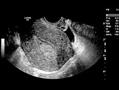 Endometrial polyp,ultrasound scan