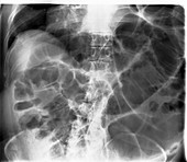 Large bowel obstruction,X-ray