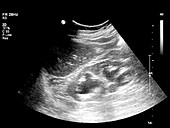 Gallstone,ultrasound scan