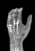 Knuckle replacement,X-ray
