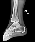 Fractured and dislocated ankle,X-ray