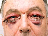 Eye bag removal surgery