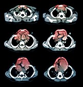 Jeune syndrome,CT scans