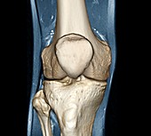 Healthy knee,CT scan