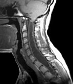 Spinal cord cyst,MRI scan