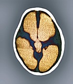 Hydrocephalus,CT scan