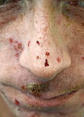 Infected skin lesions