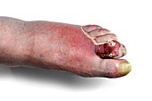 Ulcerated gout
