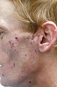 Infected skin lesions