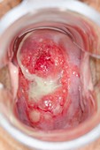 Nabothian cysts of the cervix