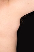 Lipoma of the armpit