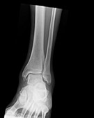 Osteoarthritis of the ankle,X-ray