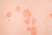 Psoriasis