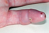 Reconnected amputated finger