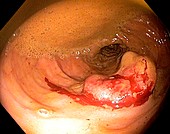 Rectal cancer,endoscope view