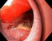 Pancreatic cancer,endoscope view