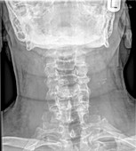 Normal Cervical spine x-ray