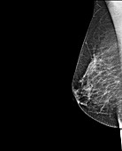 Breast Mammography