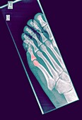 Intermediate phalanx x-ray