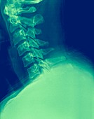 X-ray of a human Cervical spine