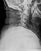 Normal Cervical spine x-ray