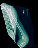 X-ray of a Human forearm