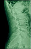 Dens fracture. Cervical spine x-ray
