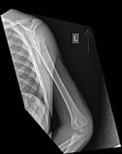 X-ray of a Human forearm
