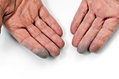 Raynaud's disease