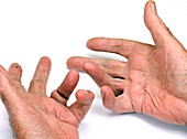 Dupuytren's contracture