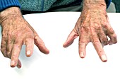 Dupuytren's contracture