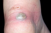 Infected blister