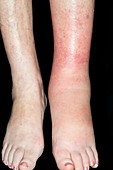 Cellulitis of the leg