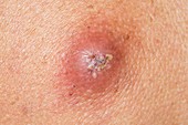 Infected sebaceous cyst