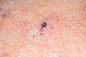 Seborrhoeic wart on the skin