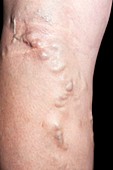 Varicose veins