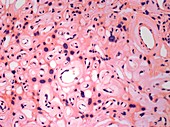 Meningioma tumour,light micrograph