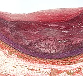Atherosclerosis,light micrograph