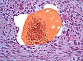 Bone tumour,light micrograph